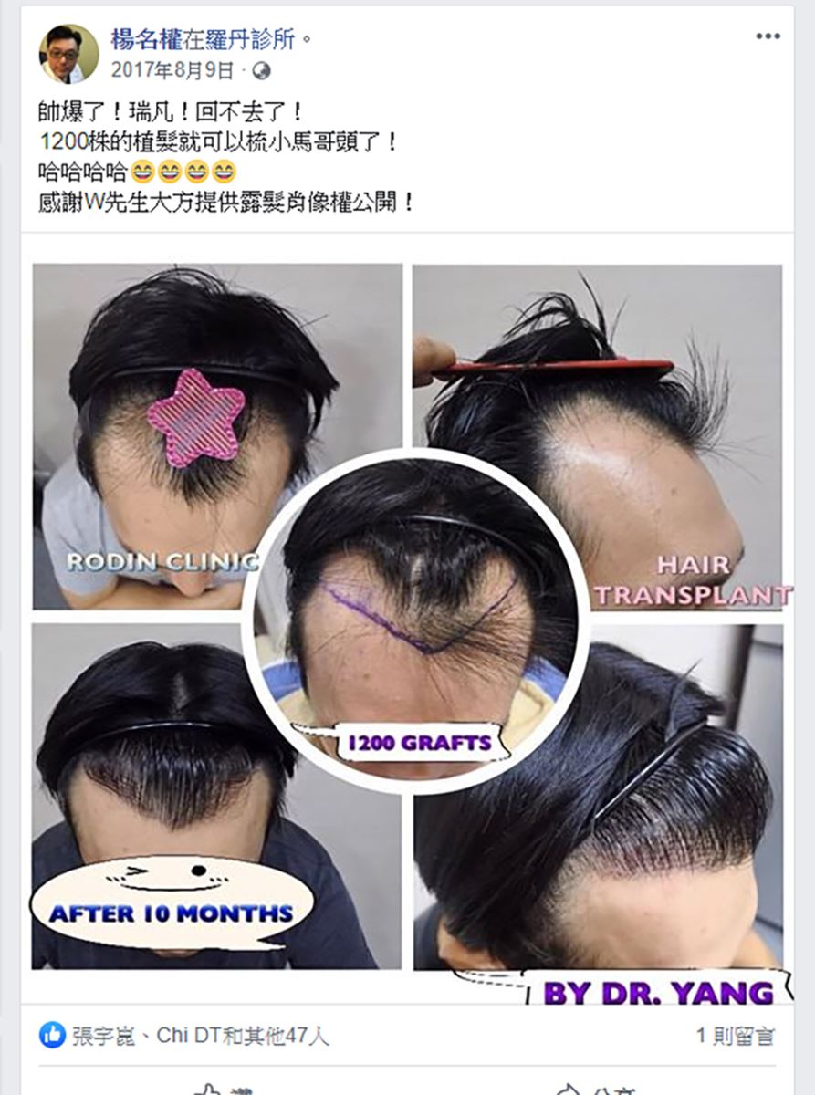 植髮,落髮,掉髮,楊名權,楊氏羅丹